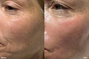 before and after of kelowna hydrafacial results showing a patient with glowing glass skin