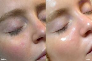 before and after of kelowna hydrafacial results showing a young patient with glowing glass skin