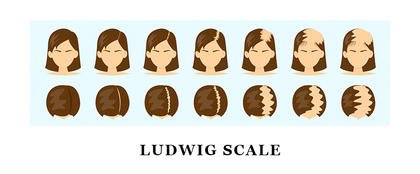 hair loss diagram depicting ludwig scale types of hair loss for females