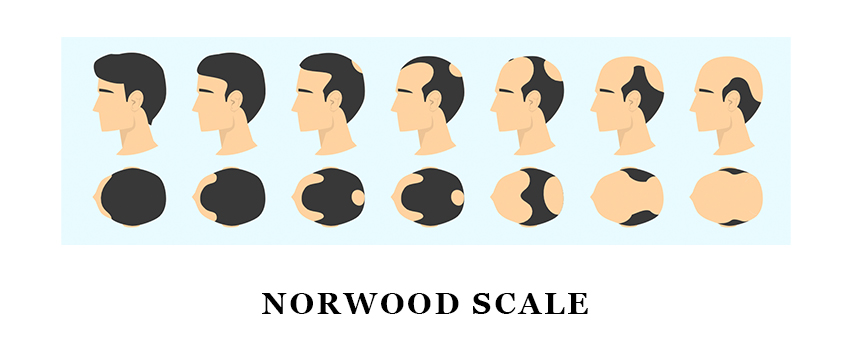 hair loss diagram depicting norwood scale types of hair loss for males