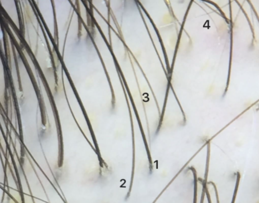 closeup androgenic alopecia