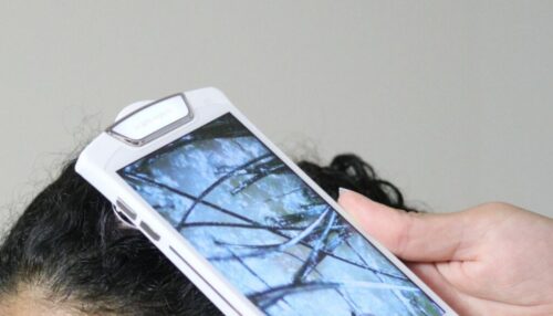 hair-loss-photo-device